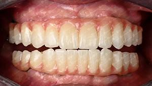 के बारे में नवीनतम कंपनी का मामला ग्राहक मामला 4D Zirconia ब्लॉक